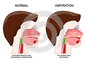 Dysphagia or aspiration. medical diagnosis