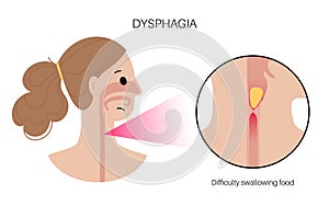 Dysphagia medical poster