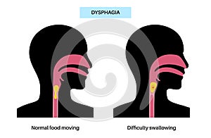 Dysphagia medical poster