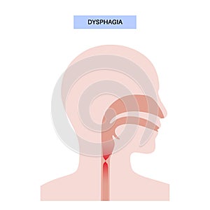 Dysphagia medical poster