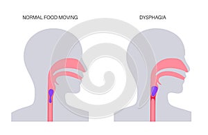 Dysphagia medical poster