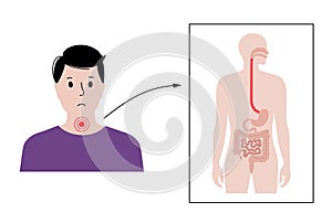 Dysphagia medical poster