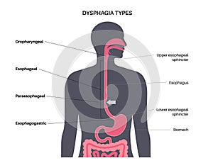 Dysphagia medical poster