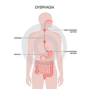 Dysphagia medical poster