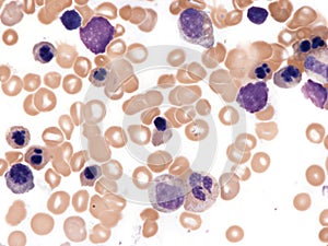 Dysplastic erythroblasts in bone marrow.