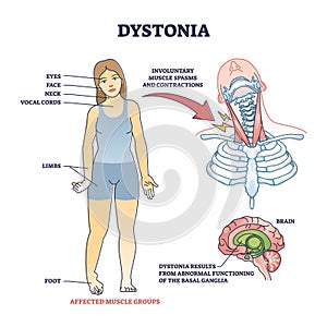 Dystonia disorder as abnormal muscle spasms and contractions outline diagram