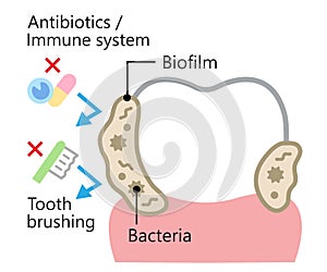 dental biofilm illustration. bacteria and plaque attachment on tooth. dental health and oral care concept photo