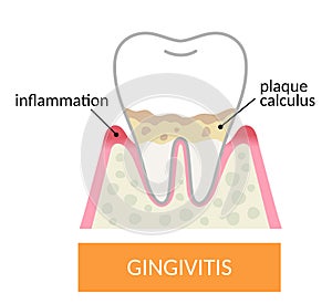gingivitis tooth and gums. plaque and calculus build up gums and inflamed. Dental and oral health care concept photo
