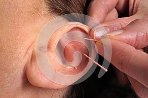 Ear acupuncture photo