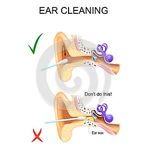Ear Cleaning with a cotton swab. Earwax Removal