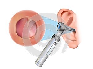 Ear examination with an otoscope. Otitis media with effusion: serous otitis media, secretory otitis media. Iinflammation photo