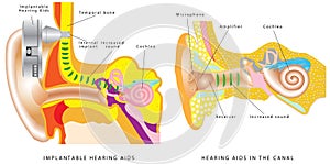 Ear hearing aid.