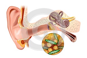 Ear infection middle ear. Bacterial ear infection. Streptococcus pneumoniae and Haemophilus influenzae