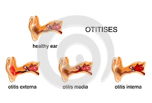 Ear. otitis media, internal, external,