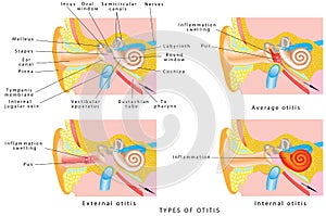 Ear otitis