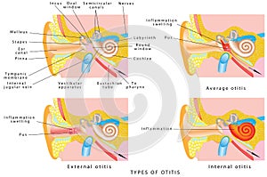 Oreja infección en el oído 