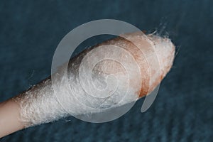 Earwax on a cotton swab, macro photo. Earwax, also known by the medical term cerumen, is a brown, orange, red, yellowish or gray