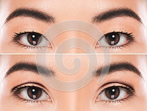 East Asian blepharoplasty or double eyelid surgery