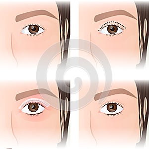 East Asian blepharoplasty, before and after images