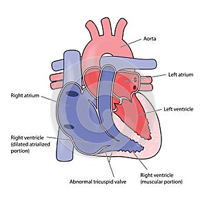 Ebstein`s heart anomaly