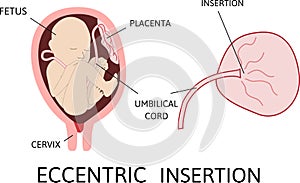 Eccentric insertion of umbilical cord. insertion site varies from the center of the fetal surface to the border of the placenta