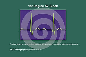 ECG of 1st degree AV block, 3D illustration