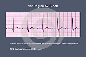 ECG of 1st degree AV block, 3D illustration