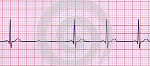 An ECG with 2nd degree Mobitz 2 AV block, 3D illustration