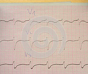 ECG