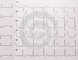 ECG