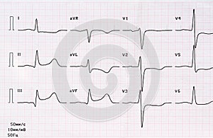 ECG with acute period of large-focal posterior diaphragmatic myocardial infarction