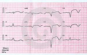 ECG with acute period of large-focal widespread anterior myocardial infarction