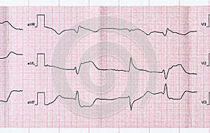 ECG with acute period macrofocal myocardial infarction and vent