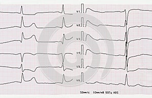 ECG with acute period of macrofocal posterior myocardial infarct