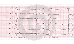 ECG with acute period of myocardial infarction, complete atrioventricular blockade