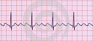 ECG in atrial flutter, 3D illustration