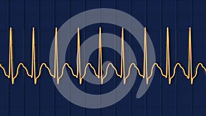 ECG in atrial flutter, 3D illustration