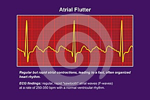 ECG in atrial flutter, an abnormal heart rhythm characterized by rapid, regular contractions of the atria, 3D