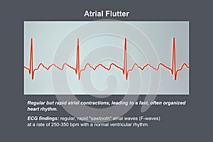 ECG in atrial flutter, an abnormal heart rhythm characterized by rapid, regular contractions of the atria, 3D