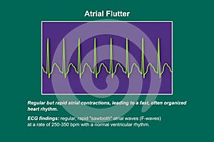 ECG in atrial flutter, an abnormal heart rhythm characterized by rapid, regular contractions of the atria, 3D