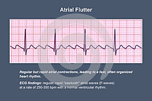 ECG in atrial flutter, an abnormal heart rhythm characterized by rapid, regular contractions of the atria, 3D