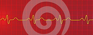 ECG of bundle branch block, 3D illustration