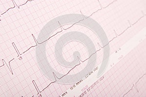 ECG chart (ECG results)