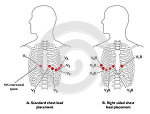 ECG chest leads