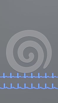 ECG comparison of normal heart rhythm and AV block.