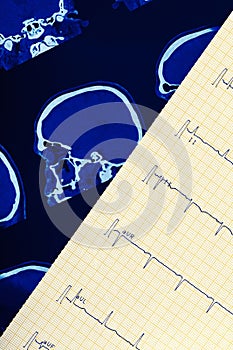 ECG and ct scan of human brain