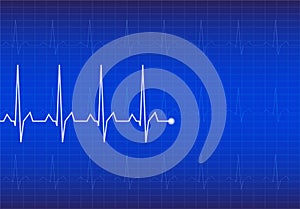 ECG Electrocardiogram,