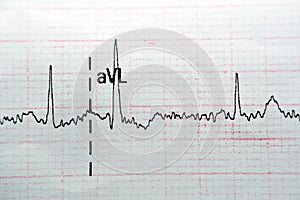 ECG ElectroCardioGraph paper that shows Normal Sinus Rhythm NSR with frequent PACs Premature Atrial Contractions, PVCs Premature