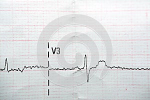 ECG ElectroCardioGraph paper that shows Normal Sinus Rhythm NSR with frequent PACs Premature Atrial Contractions, PVCs Premature photo