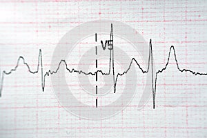 ECG ElectroCardioGraph paper that shows Normal Sinus Rhythm NSR with frequent PACs Premature Atrial Contractions, PVCs Premature photo